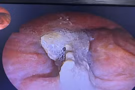 Lấy xương dài 2,5 cm mắc trong phế quản bệnh nhân 3 năm