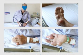 Rùng mình với tứ chi người đàn ông bị biến dạng khớp do bệnh Gout