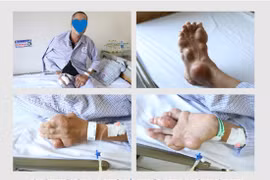 Rùng mình với tứ chi người đàn ông bị biến dạng khớp do bệnh Gout