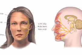 Cách điều trị liệt dây thần kinh số VII ngoại biên bằng y học cổ truyền