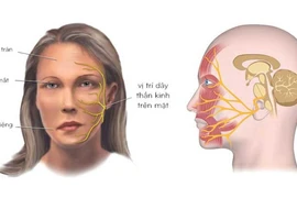 Cách điều trị liệt dây thần kinh số VII ngoại biên bằng y học cổ truyền