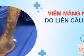 Ăn nem chua, quý ông 42 tuổi bị viêm màng não do liên cầu lợn