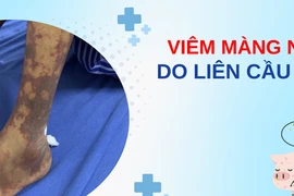 Ăn nem chua, quý ông 42 tuổi bị viêm màng não do liên cầu lợn