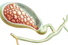 Bác sĩ chỉ thói quen tưởng vô hại nhưng dễ gây sỏi mật, polyp mật