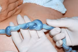 Dây rốn thắt nút là mối nguy hiểm“đe dọa hàng triệu mẹ bầu