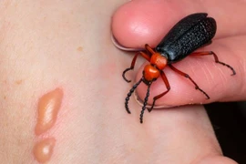 Tê bì đầu lưỡi, yếu cơ tứ chi... sau ăn sâu ban miêu: Phòng tránh sao?