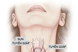 Có những dấu hiệu này, nghĩ ngay tới bệnh lý tuyến giáp