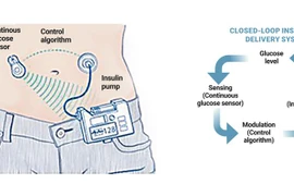 Tụy nhân tạo: Sản phẩm trí tuệ kết nối từ những người bệnh đái tháo đường