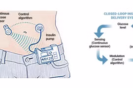 Tụy nhân tạo: Sản phẩm trí tuệ kết nối từ những người bệnh đái tháo đường
