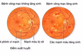 Bong võng mạc đái tháo đường 