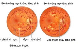 Bong võng mạc đái tháo đường 
