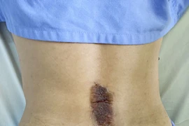 Tự đắp lá chữa đau lưng không đỡ mà còn bị bỏng da