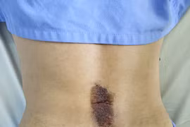 Tự đắp lá chữa đau lưng không đỡ mà còn bị bỏng da