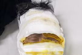 Laptop phát nổ, bé trai 08 tuổi bị bỏng nặng: phòng tránh ra sao