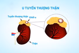 Tăng huyết áp, hạ kali máu tái diễn, đi khám phát hiện u tuyến thượng thận