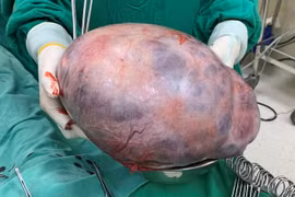 Tưởng tăng cân do tẩm bổ không ngờ... u ác buồng trứng khổng lồ