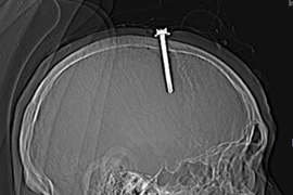 Bị trầm cảm, quý ông 63 tuổi đóng đinh sắt 5 cm vào đầu
