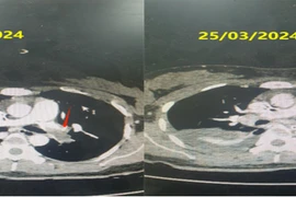 Cứu thành công sản phụ ngừng tim do thuyên tắc phổi cấp