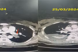 Cứu thành công sản phụ ngừng tim do thuyên tắc phổi cấp