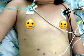 Phát ban đỏ toàn thân, trẻ nguy kịch do viêm não mô cầu