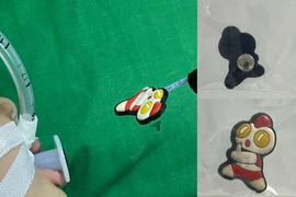 Nuốt hình ngộ nghĩnh gắn dép bé 17 tháng nội soi gây mê lấy dị vật