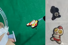 Nuốt hình ngộ nghĩnh gắn dép bé 17 tháng nội soi gây mê lấy dị vật