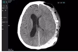 Cứu sống bệnh nhân bị tai nạn chấn thương sọ não, tiên lượng rất nặng