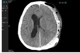 Cứu sống bệnh nhân bị tai nạn chấn thương sọ não, tiên lượng rất nặng