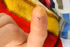 Sau vài phút bị cu li cắn, quý ông 31 tuổi đã sốc phản vệ