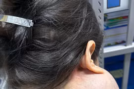 Suýt mất mạng vì 14 năm không điều trị u “khổng lồ” trên mặt