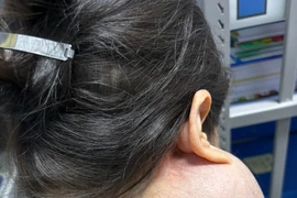 Suýt mất mạng vì 14 năm không điều trị u “khổng lồ” trên mặt