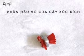 Lấy dị vật âm đạo cho bé gái 5 tuổi tránh vô sinh