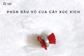 Lấy dị vật âm đạo cho bé gái 5 tuổi tránh vô sinh