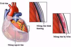 Mệt mỏi kéo dài, bệnh nhân nam 47 tuổi không ngờ viêm nội tâm mạc
