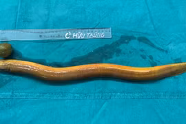  Thanh niên 31 tuổi suýt "mất mạng" vì nhét con lươn 65cm vào hậu môn