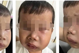 Trẻ sâu răng cẩn thận biến chứng viêm tủy răng gây nhiễm trùng máu