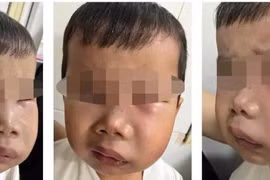 Trẻ sâu răng cẩn thận biến chứng viêm tủy răng gây nhiễm trùng máu