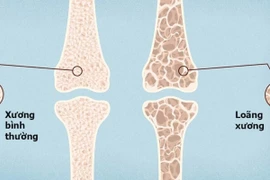 3,5 triệu người Việt loãng xương: hệ lụy của gãy xương ở người già