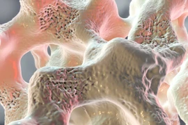 Những thói quen “vô thưởng vô phạt” âm thầm tàn phá xương khớp