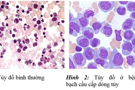 Biểu hiện tủy đồ của bệnh máu trắng 