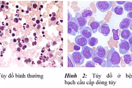 Biểu hiện tủy đồ của bệnh máu trắng 
