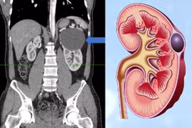 Nang đơn thận có nguy hiểm?