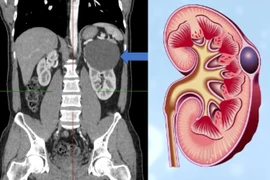 Nang đơn thận có nguy hiểm?