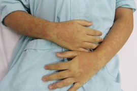 Bé 12 tuổi sốc phản vệ sau ăn cù kỳ