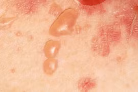 PEMPHIGUS - Một bệnh tự miễn rất nguy hiểm