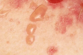 PEMPHIGUS - Một bệnh tự miễn rất nguy hiểm