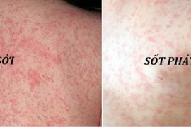 Sởi tăng 8 lần, ho gà tăng 25 lần: Bộ Y tế chỉ đạo phòng dịch