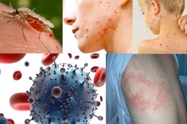 Sởi, ho gà, thủy đậu tăng, Bộ Y tế chỉ đạo phòng chống dịch dịp 30/4-1/5