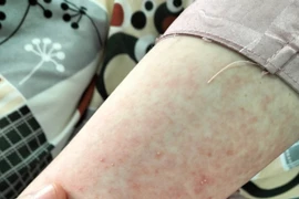 Tự mua thuốc chữa long đờm, bé 13 tuổi bị nổi mụn mủ toàn thân 