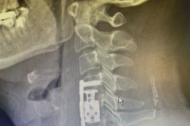 Thay đốt sống cổ nhân tạo cho người thoát vị cột sống cổ 10 năm